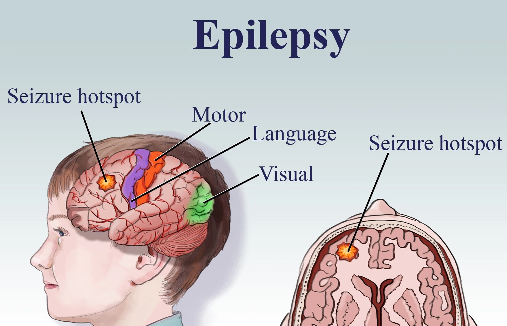 Epilepsy and Seizure Disorder